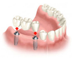 Dental Implant Retained Bridge San Jose