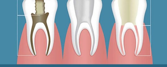 Facts to know about root canal therapy