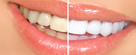 What are the five most typical Cosmetic dental procedures?